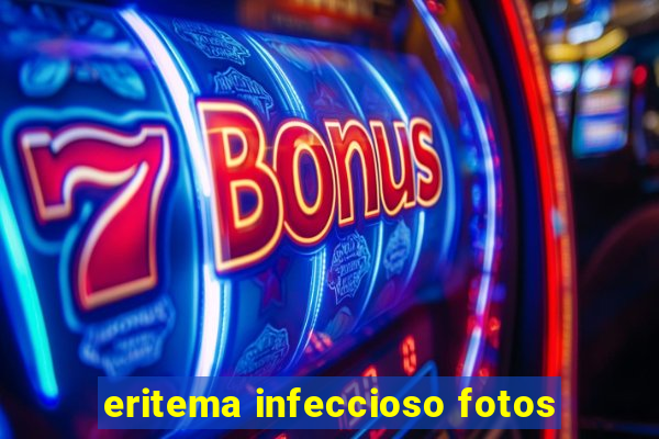 eritema infeccioso fotos